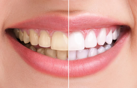 歯のホワイトニング - 合志アンビー歯科・矯正歯科（合志市）